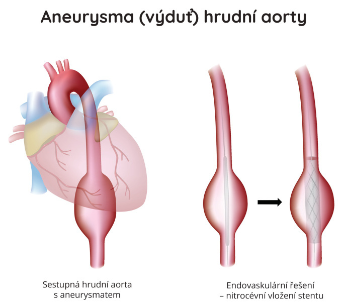 Aneurysma (výduť) hrudní aorty