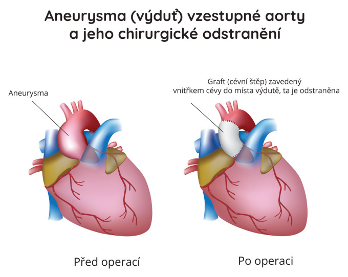 Aneurysma (výduť) vzestupné aorty a jeho chirurgické odstranění