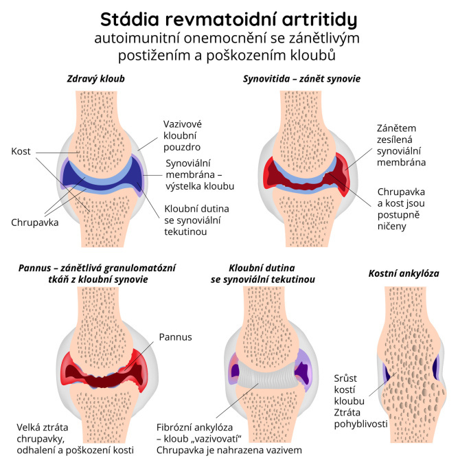 Stádia revmatoidní artritidy