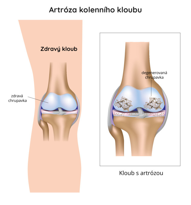 Artróza kolenního kloubu.jpg
