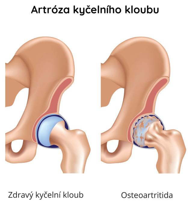Artróza kyčelního kloubu