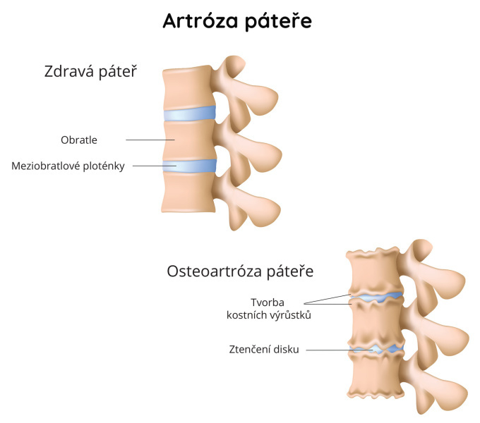 Artroza páteře