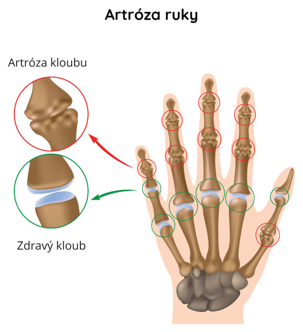 Artróza ruky