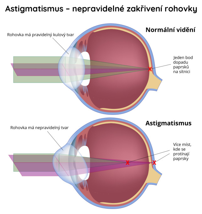 Astigmatismus - nepravidelné zakřivení rohovky