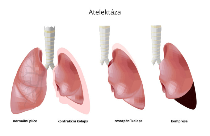Atelektáza