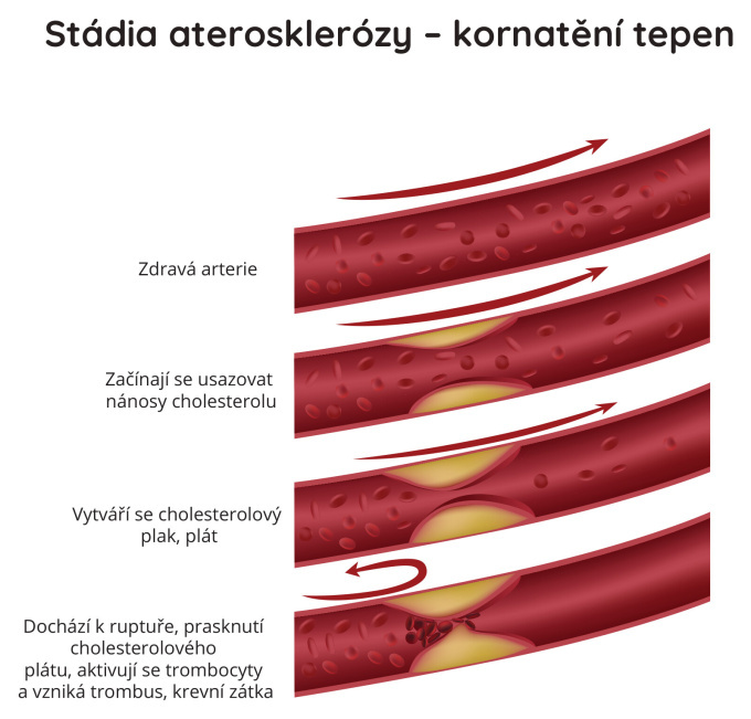Stádia aterosklerózy - kornatění tepen