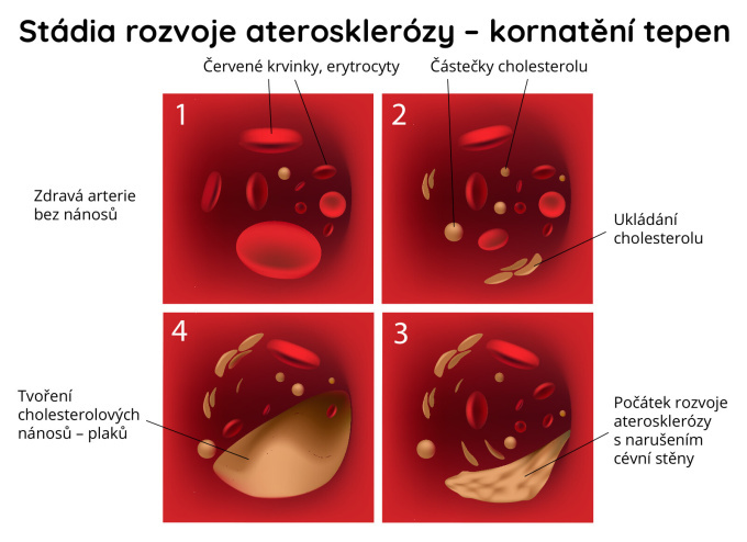 Stádia rozvoje aterosklerózy