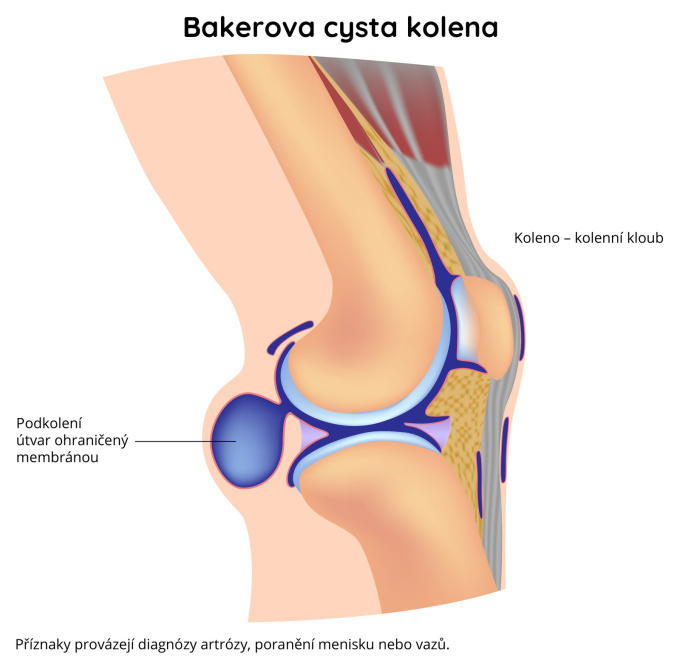Bakerova cysta