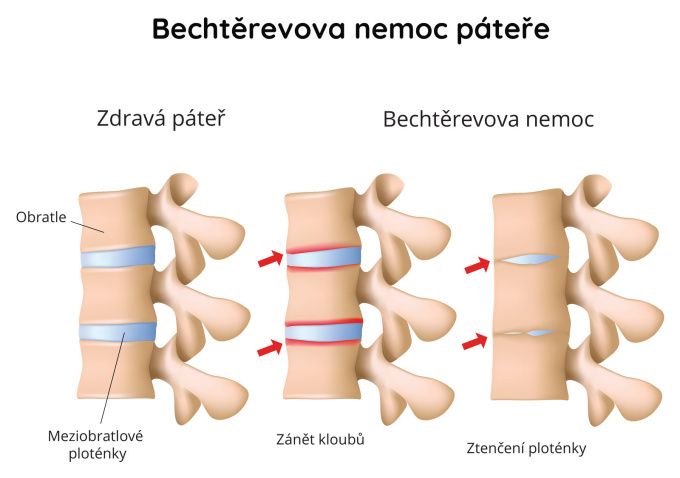 Bechtěrevova nemoc páteře