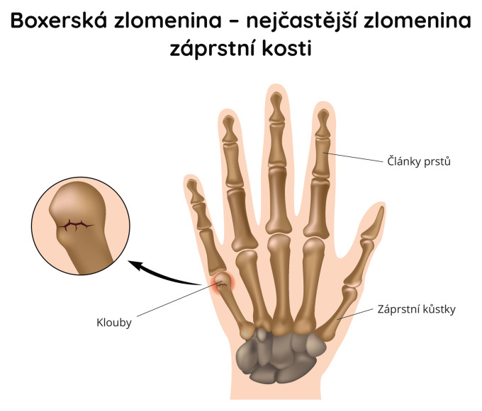 Zlomeniny boxera - nejčastější zlomeniny prstu
