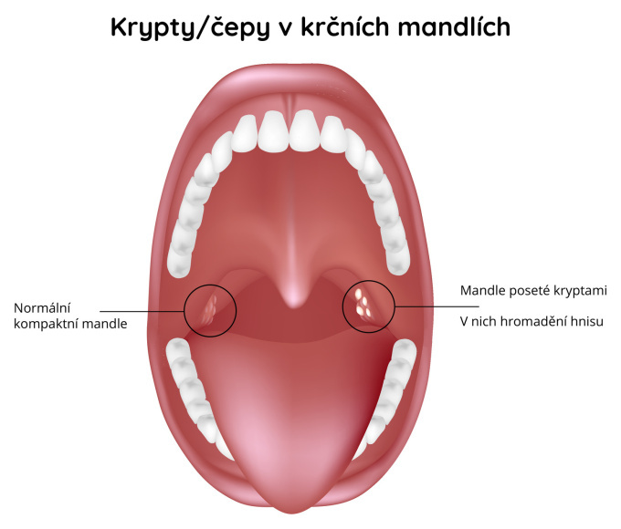 Krypty - čepy na krčních mandlích
