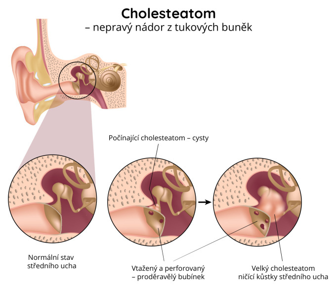 Cholesteatom