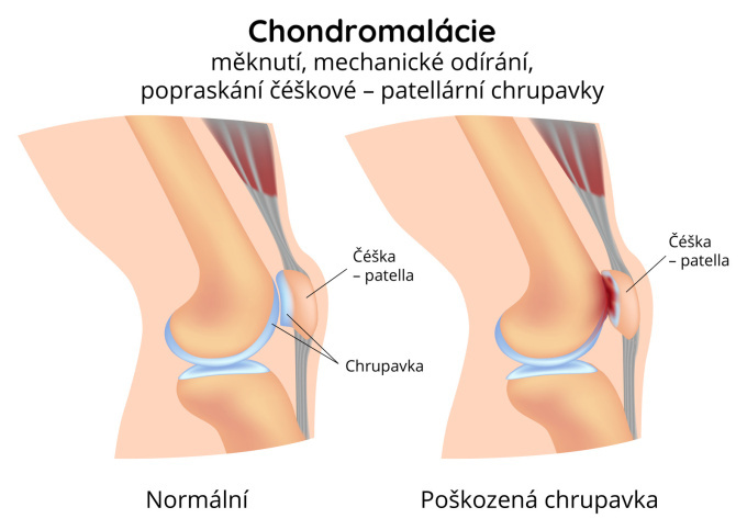 Chondromalácie (měknutí) čéšky