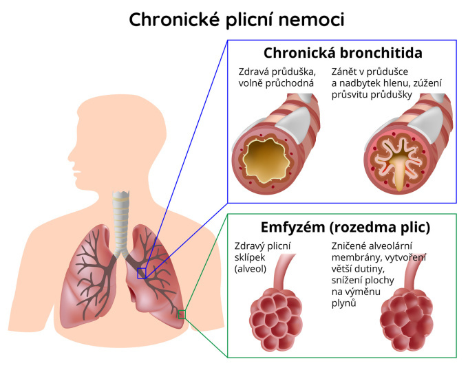Chronické plicní nemoci