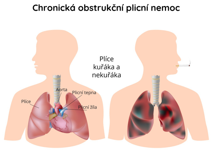 Plíce při chronické obstrukční plicní nemoci