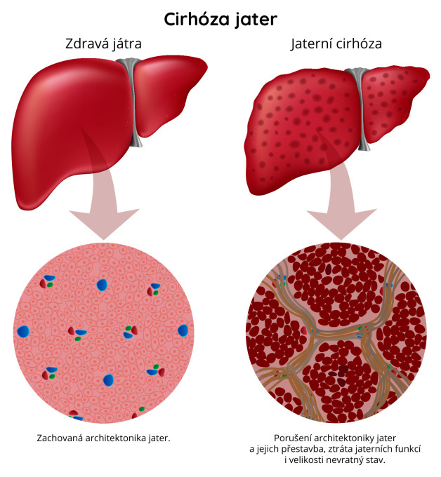 zdravá játra a jaterní cirhóza