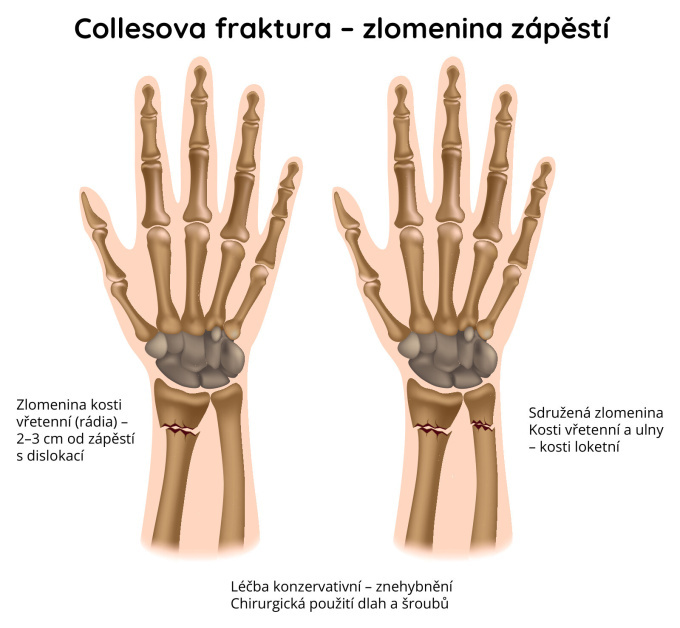 Collesova fraktura - zlomenina zápěstí