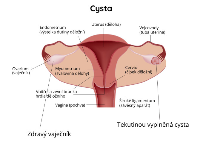 Ovariální cysta