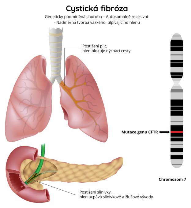 Cystická fibróza
