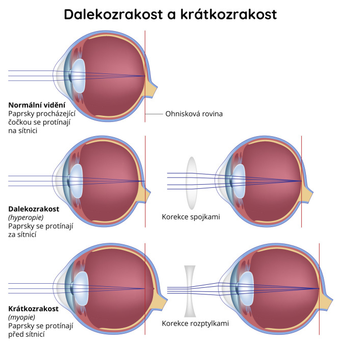 Dalekozrakost a krátkozrakost