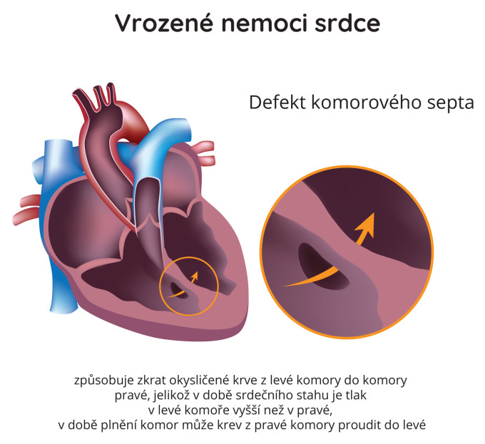 Defekt komorového septa