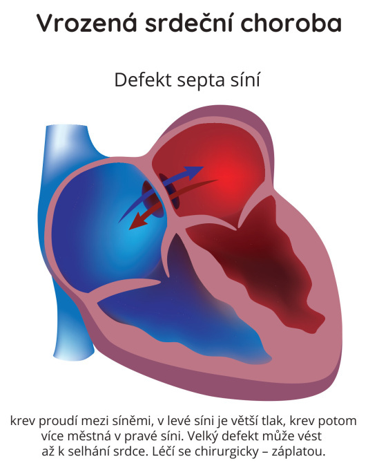 Vrozená srdeční choroba - defekt septa síní