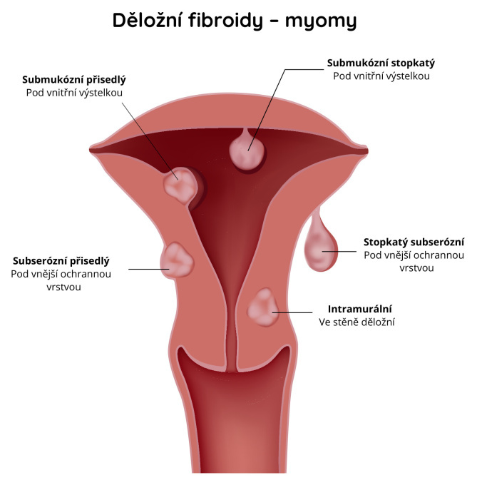 Děložní fibroidy---myomy
