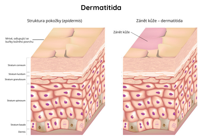 Dermatitida - zánět kůže