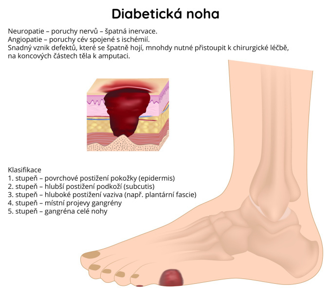 Diabetická noha