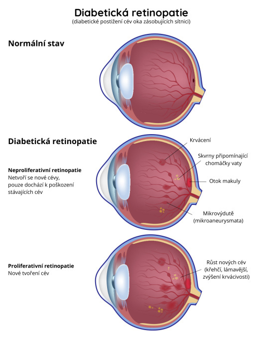 Diabetická retinopatie