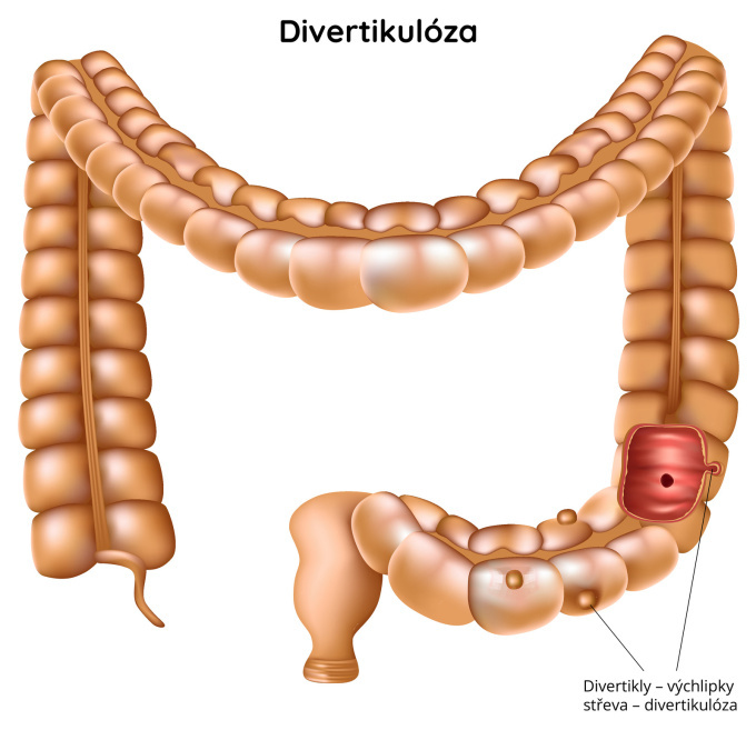 Divertikulóza