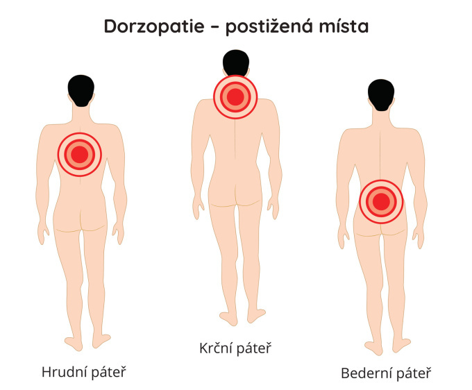Dorzopatie - postižená místa