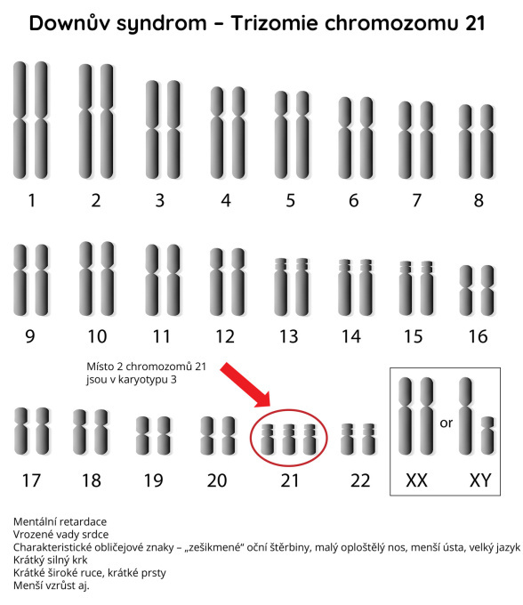 Trizomie chromozomu 21