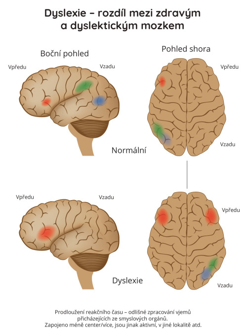 Dyslexie - rozdíl mezi zdravým a dyslektickým mozkem