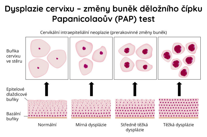 Dysplazie cervixu - změny-buněk děložního čípku