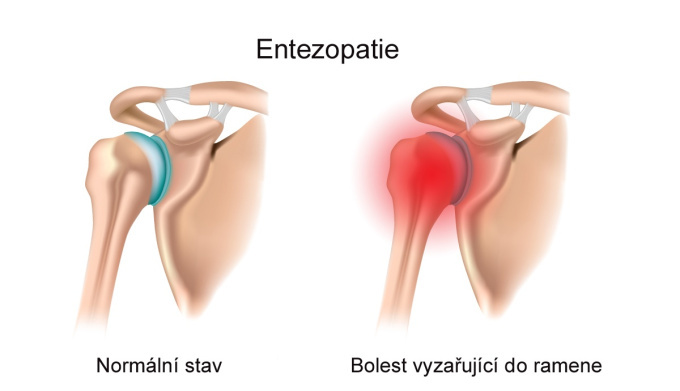 Entezopatie.jpg