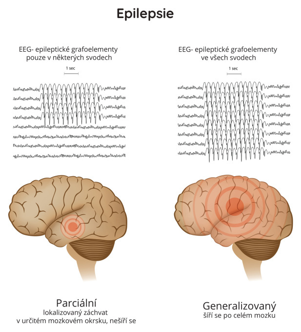 Epilepsie - parciální a generalizovaný záchvat