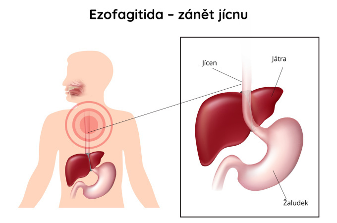 Ezofagitida - zánět jícnu