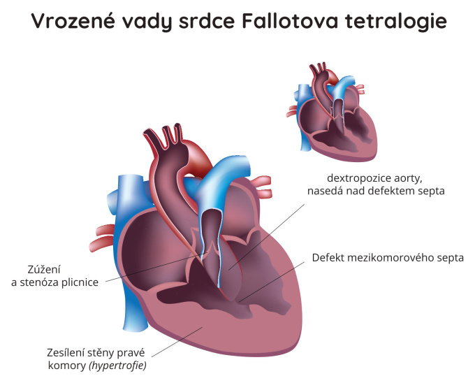 Fallotova tetralogie