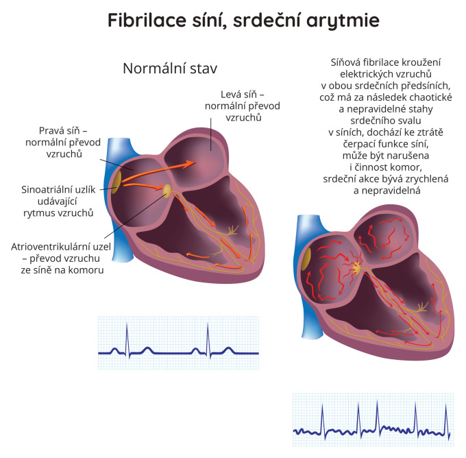 Fibrilace síní, srdeční arytmie