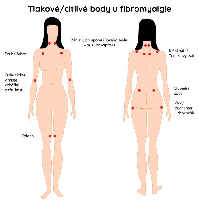 Tlakové - citlivé body u fibromyalgie