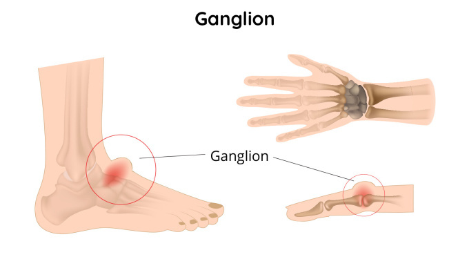 Ganglion na ruce a noze