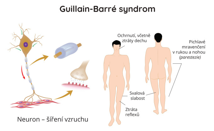 Guillain-Barré syndrom, GBS