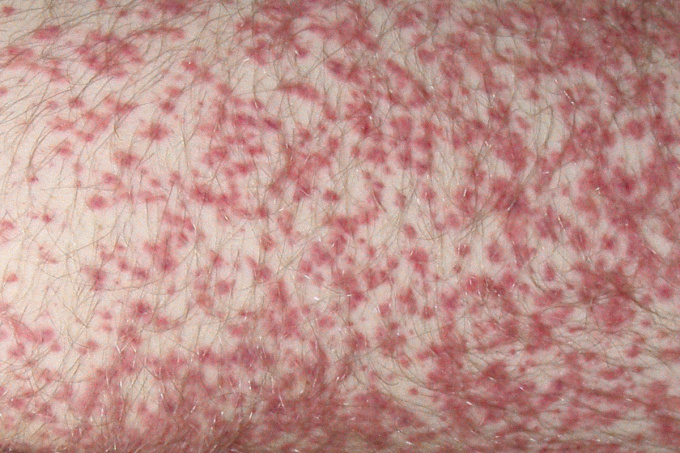 Henochova-Schönleinova purpura (HSP)