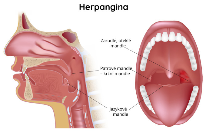 Herpangina - oteklé uzliny