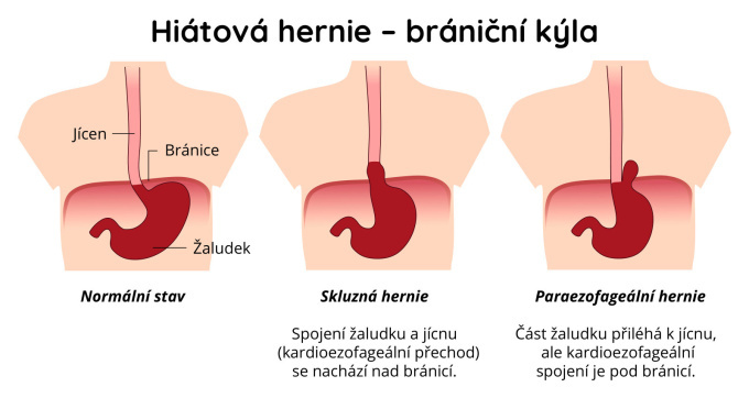 Hiátová hernie – brániční kýla