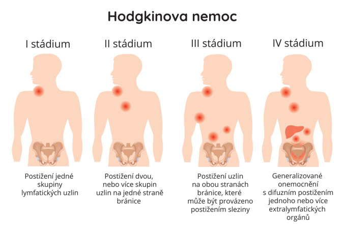 Stádia Hodgkinova lymfomu