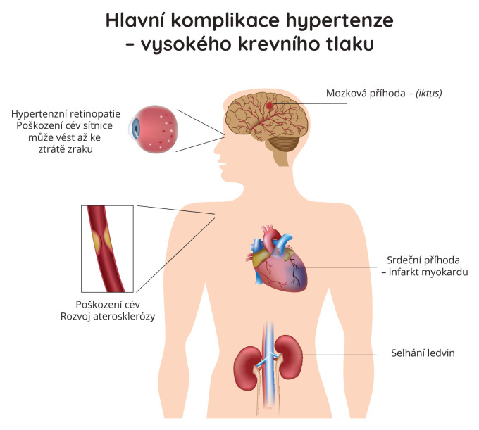 Hlavní komplikace hypertenze - vysokého krevního tlaku