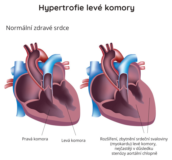 Hypertrofie levé komory