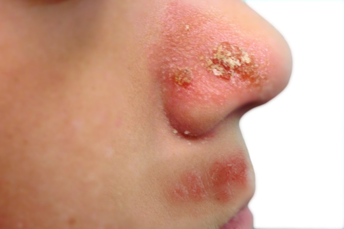 impetigo pod nosem